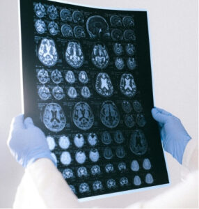 Medical professional examining brain MRI results — despite a normal scan, headaches may persist