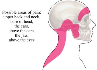 Ares of pain in a tension headache