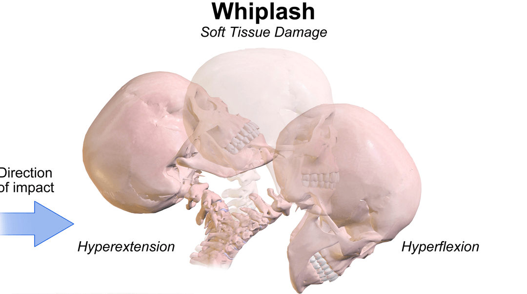 Whiplash Associated Disorders (WAD)