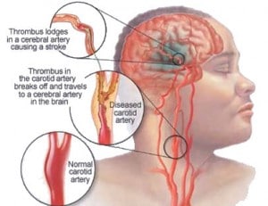 stroke headaches and migraines